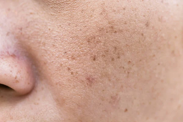 Pecas Sobre Mujer Asiática Cara Problemas Piel — Foto de Stock