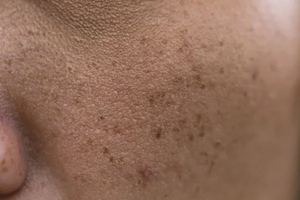 亚洲女人脸上的雀斑 皮肤问题 — 图库照片