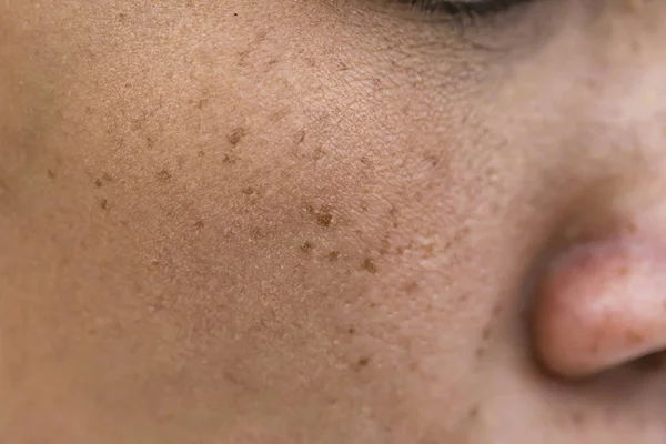 Pecas Sobre Mujer Asiática Cara Problemas Piel — Foto de Stock