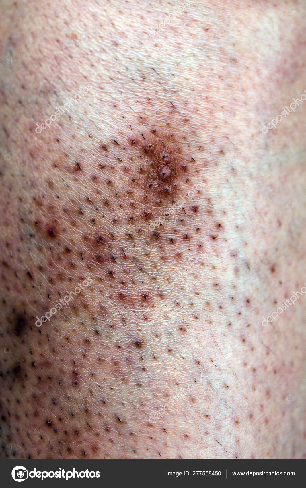 oily skin acne scars