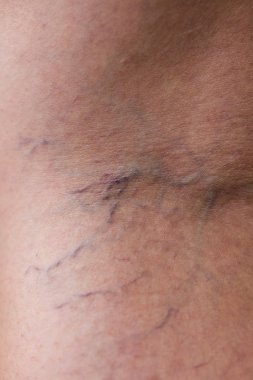 Kadın bacaklarında acı verici varis ve örümcek damarları, aktif yaşam konsepti..