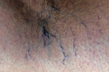 Kadın bacaklarında acı verici varis ve örümcek damarları, aktif yaşam konsepti..