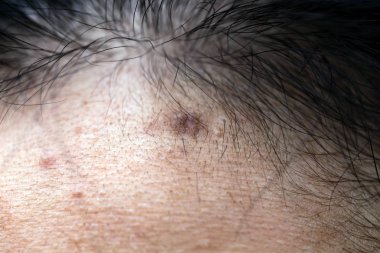 Kadınların sorunlu derileri, sivilce izleri, yağlı cilt ve gözenekler, koyu lekeler ve siyah noktalar ve yüzünde beyaz başlıklar.