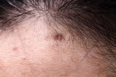 Kadınların sorunlu derileri, sivilce izleri, yağlı cilt ve gözenekler, koyu lekeler ve siyah noktalar ve yüzünde beyaz başlıklar.