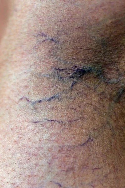 女性の足の痛みを伴う静脈瘤やクモの静脈 アクティブライフコンセプト — ストック写真