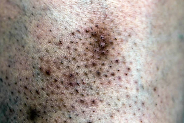 Piel Problemática Mujer Cicatrices Acné Piel Grasa Poros Manchas Oscuras —  Fotos de Stock