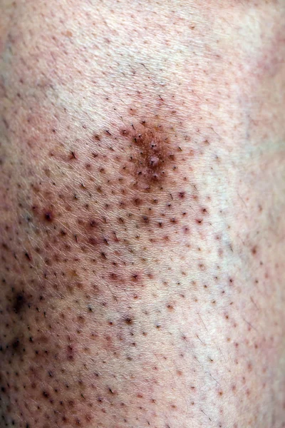 Kvinnans Problematiska Hud Akne Ärr Fet Hud Och Porer Mörka — Stockfoto
