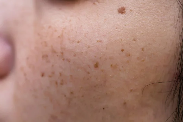 Pelle Problematica Della Donna Cicatrici Acne Pelle Grassa Pori Macchie — Foto Stock