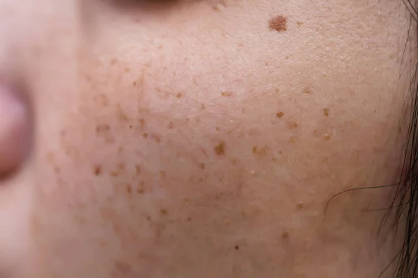 Pele Problemática Mulher Cicatrizes Acne Pele Oleosa Poro Manchas Escuras Fotos De Bancos De Imagens