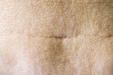 Asya Yüz Üzerinde Çiller, Cilt Sorunları