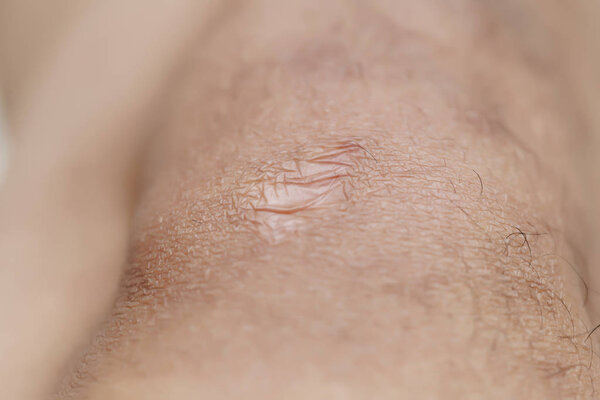 Close up of cyanotic keloid scar caused by surgery and suturing