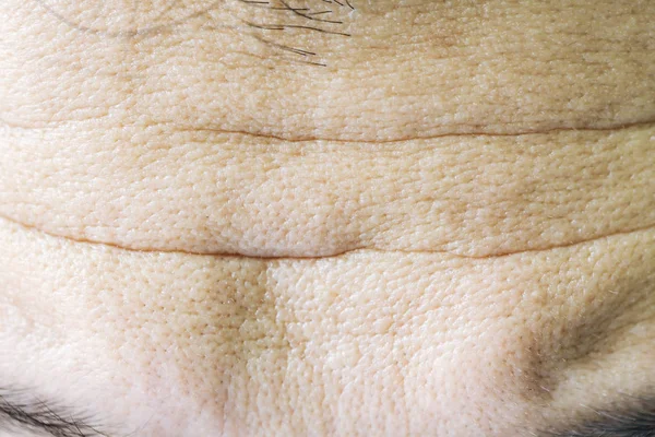 アジアの顔のそばかす 皮膚の問題 — ストック写真