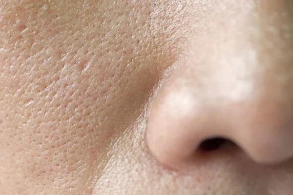 アジアの顔のそばかす 皮膚の問題 — ストック写真