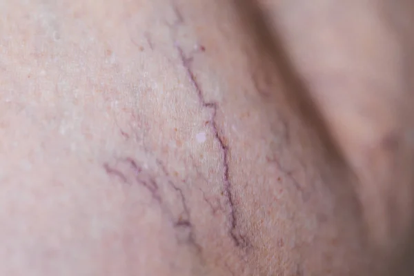 Kadın Bacaklarında Acı Verici Varis Örümcek Damarları Aktif Yaşam Konsepti — Stok fotoğraf