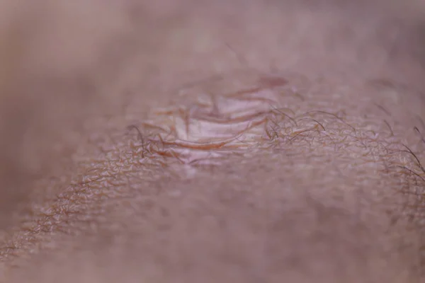 Close Cyanotic Keloid Scar Caused Surgery Suturing — Stock Photo, Image