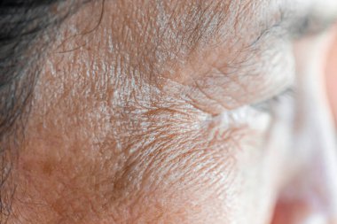 Kadınların sorunlu derileri, sivilce izleri, yağlı cilt ve gözenekler, koyu lekeler ve siyah noktalar ve yüzünde beyaz başlıklar.