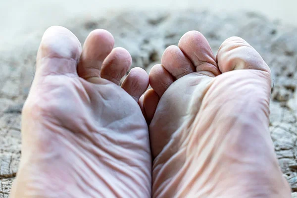 Closeup view of feet with dry skin Cracks on a Heel.