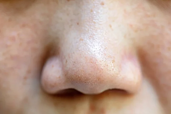 Pimples Pores Nose Asian People — Stock Photo, Image