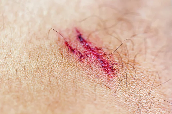 Blood Flowed Skin Due Abrasions — Stock Photo, Image