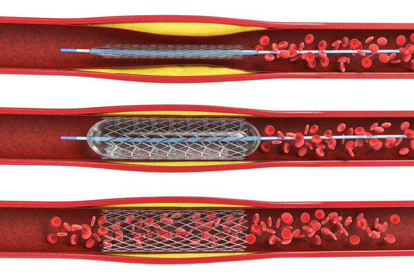 Balloon angioplasty procedure 