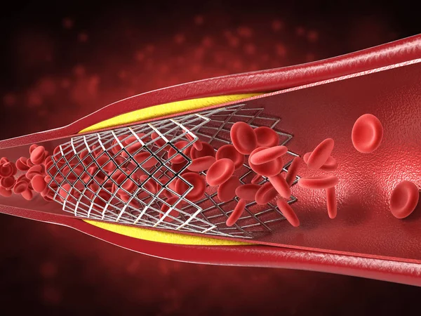 Angioplastia con balón — Foto de Stock