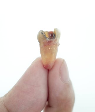 beyaz zemin üzerinde bir insan elinde molar diş çürüğü