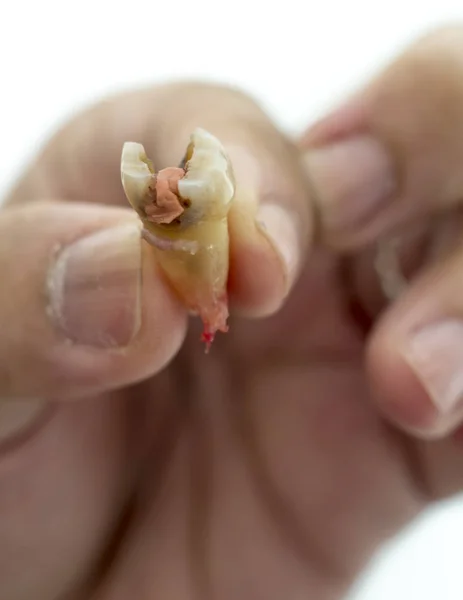 Decay Molar Tooth Human Hand White Background — Stock Photo, Image