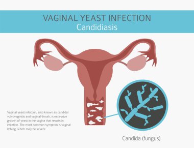 Vajinal mantar enfeksiyonu. Kandidiyazis. Ginecological tıbbi desease Infographic. Vektör çizim