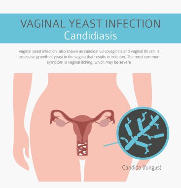 Vajinal mantar enfeksiyonu. Kandidiyazis. Ginecological tıbbi desease Infographic. Vektör çizim