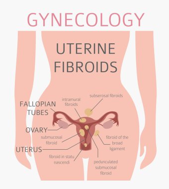 Uterin fibroids. Ginecological tıbbi desease kadınlar Infographic içinde. Vektör çizim
