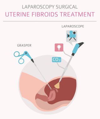 Uterin fibroids. Ginecological tıbbi desease kadınlar Infographic içinde. Vektör çizim