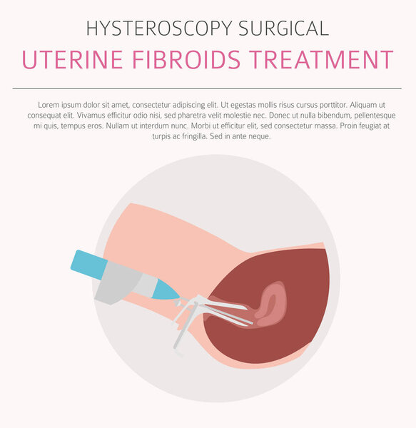 Uterine fibroids. Ginecological medical desease in women infographic. Vector illustration