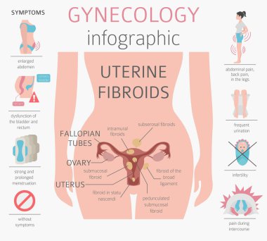 Uterin fibroids. Ginecological tıbbi desease kadınlar Infographic içinde. Vektör çizim