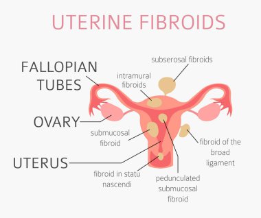Uterin fibroids. Ginecological tıbbi desease kadınlar Infographic içinde. Vektör çizim