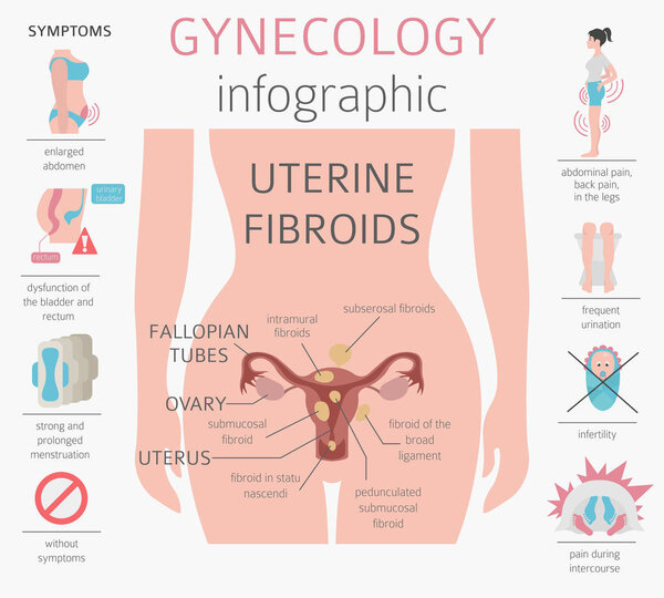 Uterine fibroids. Ginecological medical desease in women infographic. Vector illustration
