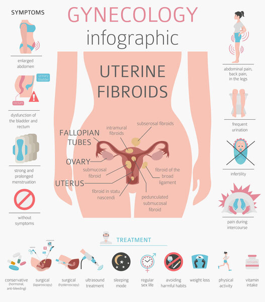 Uterine fibroids. Ginecological medical desease in women infographic. Vector illustration