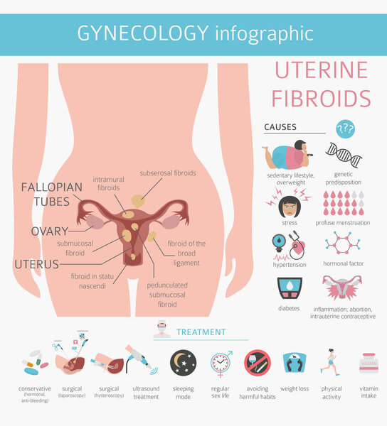 Uterine fibroids. Ginecological medical desease in women infographic. Vector illustration