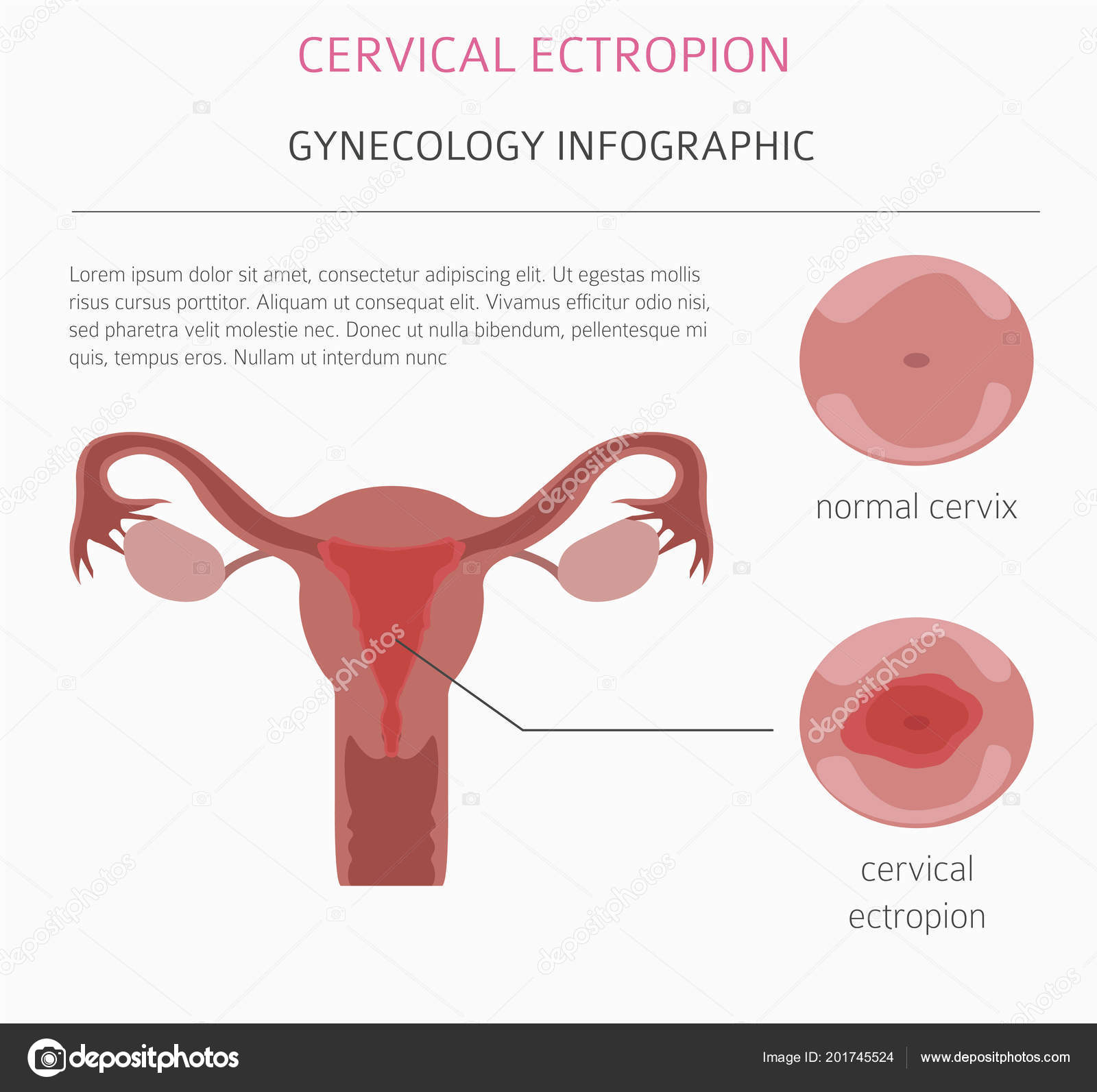 Cervical Ectropion Cervical Ectropion