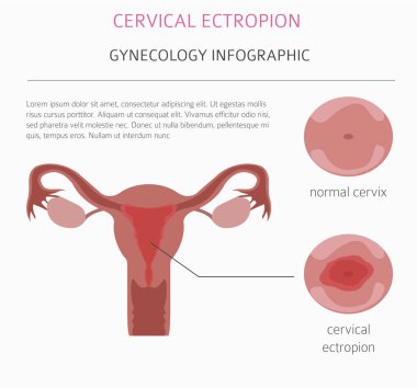 Servikal ectropion. Ginecological tıbbi desease Infographic. Vektör çizim