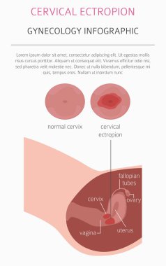 Servikal ectropion. Ginecological tıbbi desease Infographic. Vektör çizim