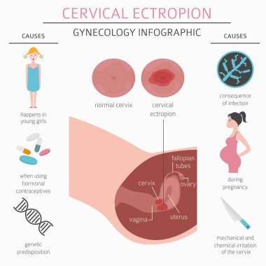 Servikal ectropion. Ginecological tıbbi desease Infographic. Vektör çizim