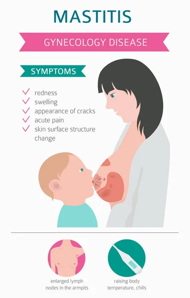 Mastitis Lactancia Materna Infografía Médica Diagnósticos Síntomas Tratamiento Conjunto Iconos — Archivo Imágenes Vectoriales