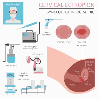 Servikal ectropion. Ginecological tıbbi desease Infographic. Vektör çizim