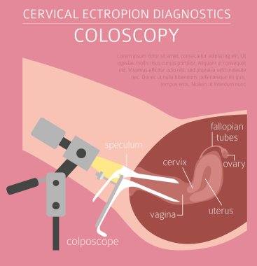 Servikal ectropion. Ginecological tıbbi desease Infographic. Vektör çizim