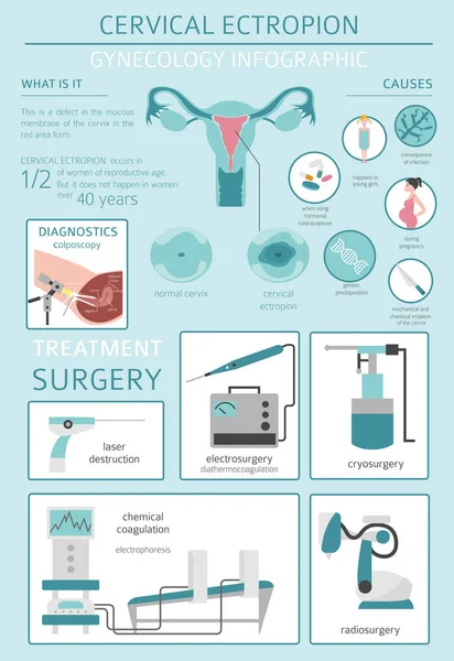 Ectropione Cervicale Infografica Sulla Malattia Medica Ginecologica Illustrazione Vettoriale — Vettoriale Stock