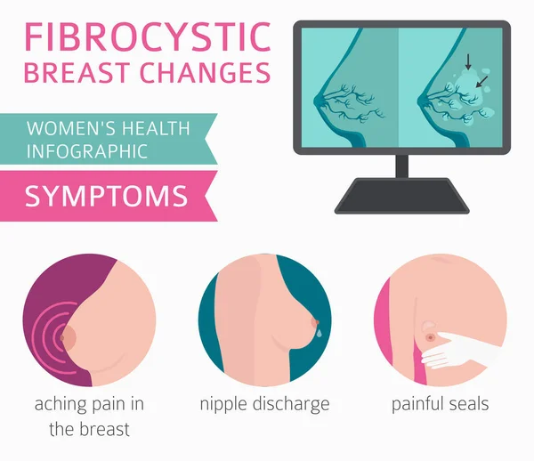 Fibrocystic Infographic 변경합니다 치료입니다 여자의 아이콘 세트입니다 일러스트 — 스톡 벡터