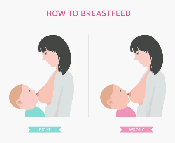 乳房炎 母乳喂养 医疗图表 妇女健康图标设置 矢量插图 — 图库矢量图片