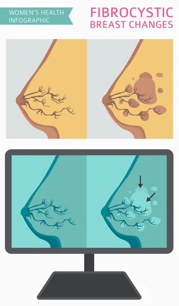 Fibrocystiska Förändringar Bröstsjukdom Medicinsk Infographic Diagnostik Symtom Behandling Kvinnors Hälsa — Stock vektor