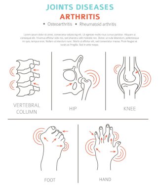 Eklem hastalıkları. Artrit belirtileri, tedavisi Icon set. Tıbbi Infographic tasarım. Vektör çizim