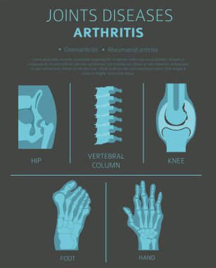 Eklem hastalıkları. Artrit belirtileri, tedavisi Icon set. Tıbbi Infographic tasarım. Vektör çizim